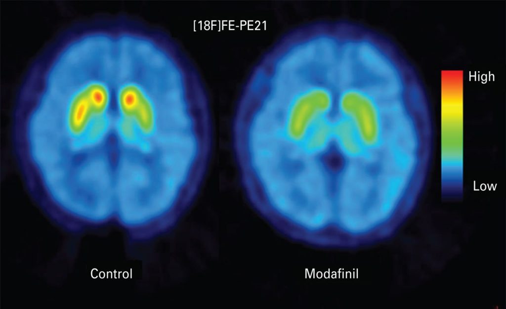 Brain scan showing key differences between placebo brains and modafinil-treated brains